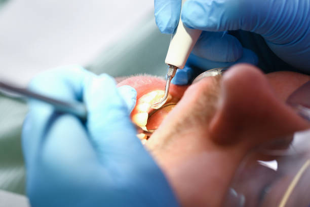 Best Emergency Dental Care for Broken or Chipped Teeth in Fairfield University, CT